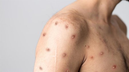 127078-113063monkeypoxbody1280