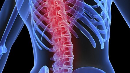 osteoporosi-e1489562527304